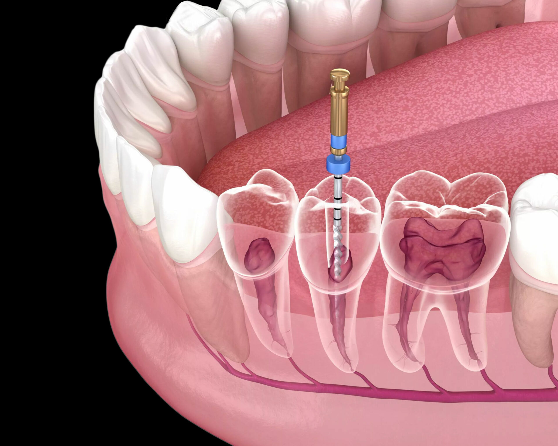 endodontic-root-canal-treatment-process-medically-scaled-1